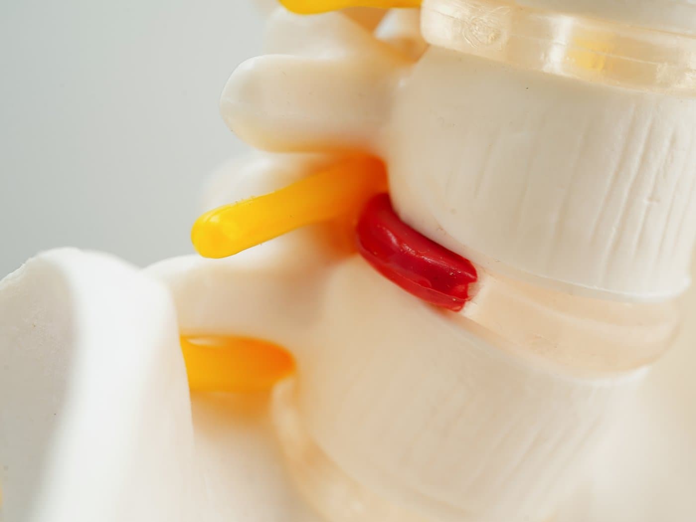 Close-up of a spine model showing an intervertebral disc highlighted in red, next to a yellow nerve root.