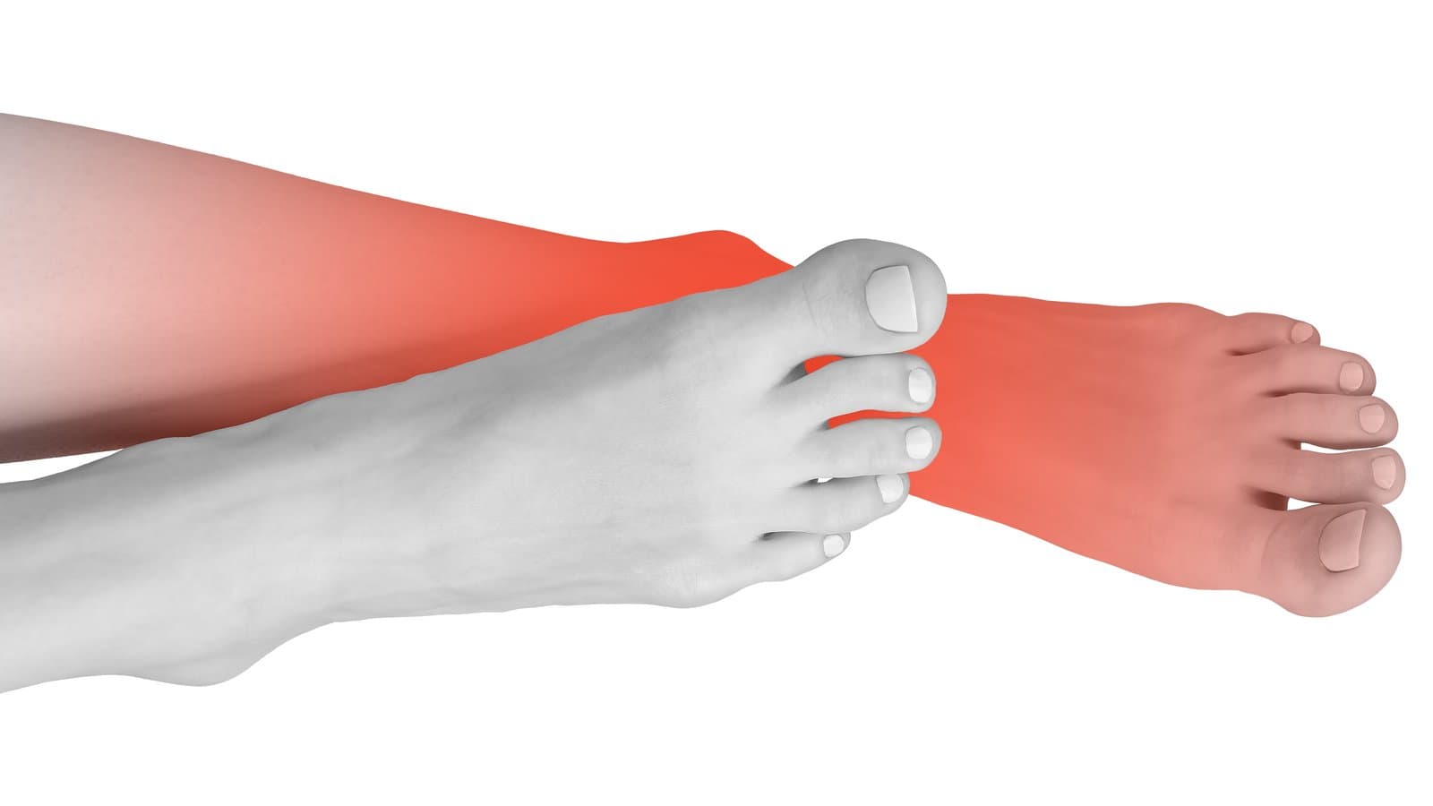 Illustration of both feet with a symmetric, bilateral 'stocking distribution' pattern of nerve pain highlighted in red.