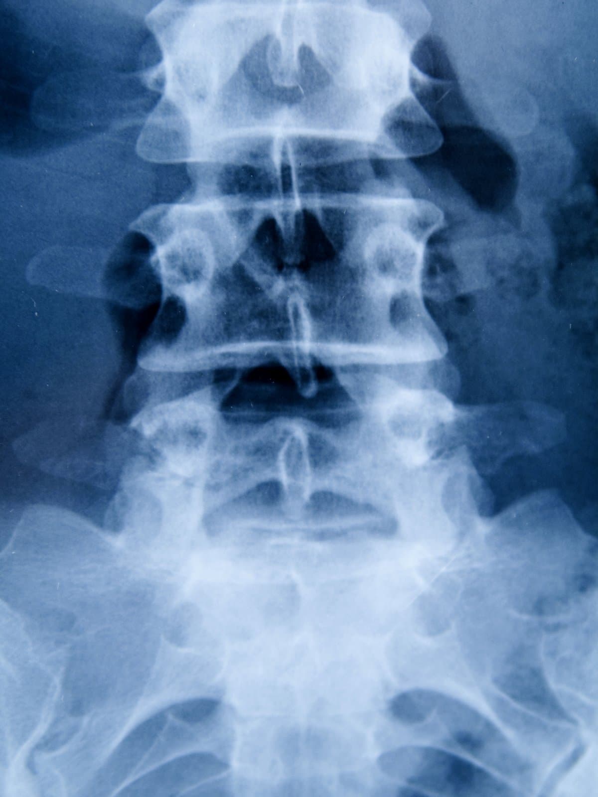 An AP X-ray of the lumbar spine, blue-toned.