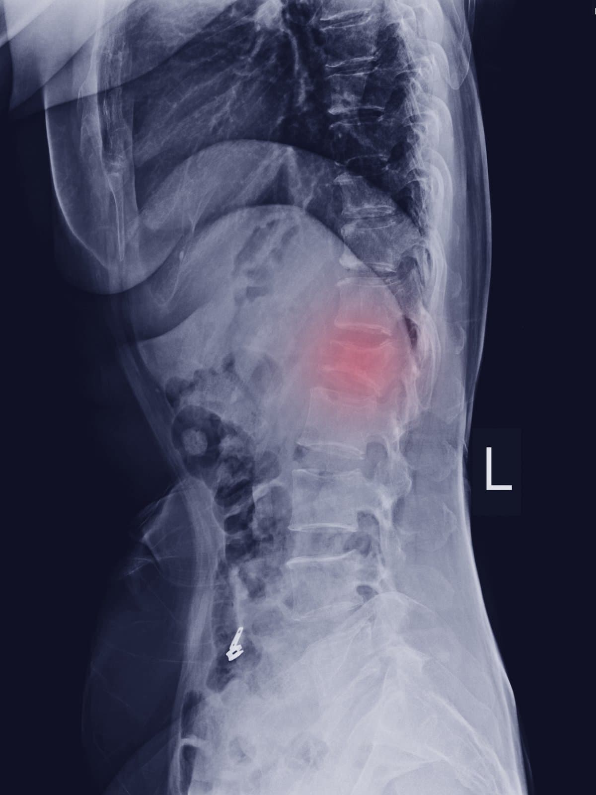 A lateral lumbar spine X-ray showing a compressed vertebra highlighted in red.