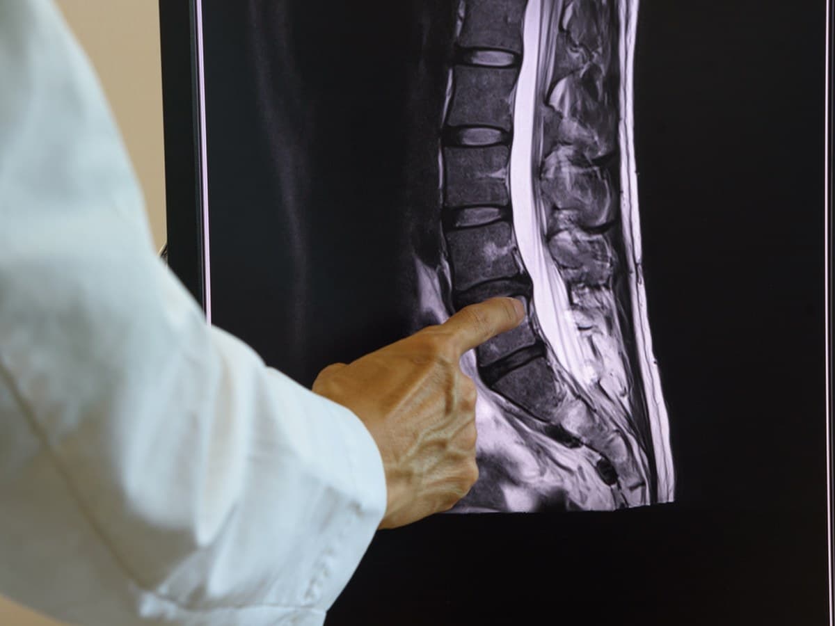 A physician's hand pointing at a lumbar spine MRI displayed on a monitor.