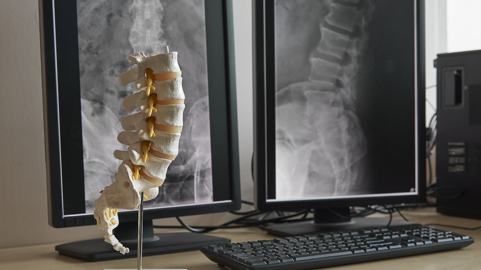 A model of the lumbar spine on a desk stand, positioned in front of two monitors displaying a patient's spinal X-rays.