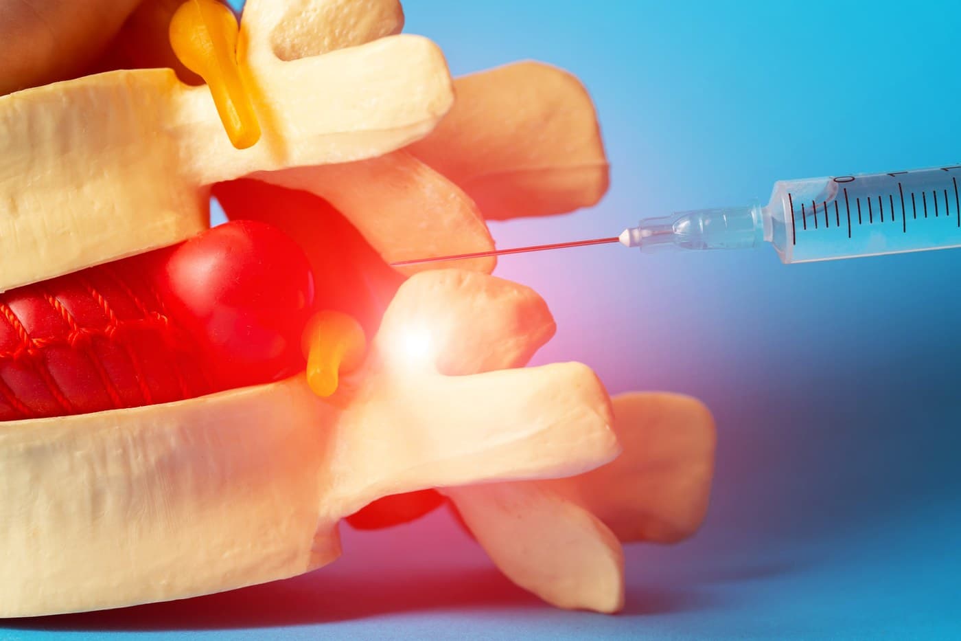 A syringe and needle inserted into a spine model near the epidural space, with the disc and nerve root highlighted in red.