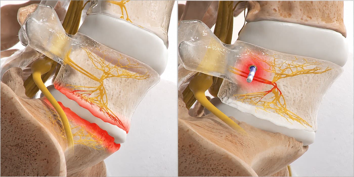 Side-by-side comparison showing a vertebral body with the basivertebral nerve pathway highlighted in red, and a probe inserted through the vertebral body to ablate the nerve in the second panel.