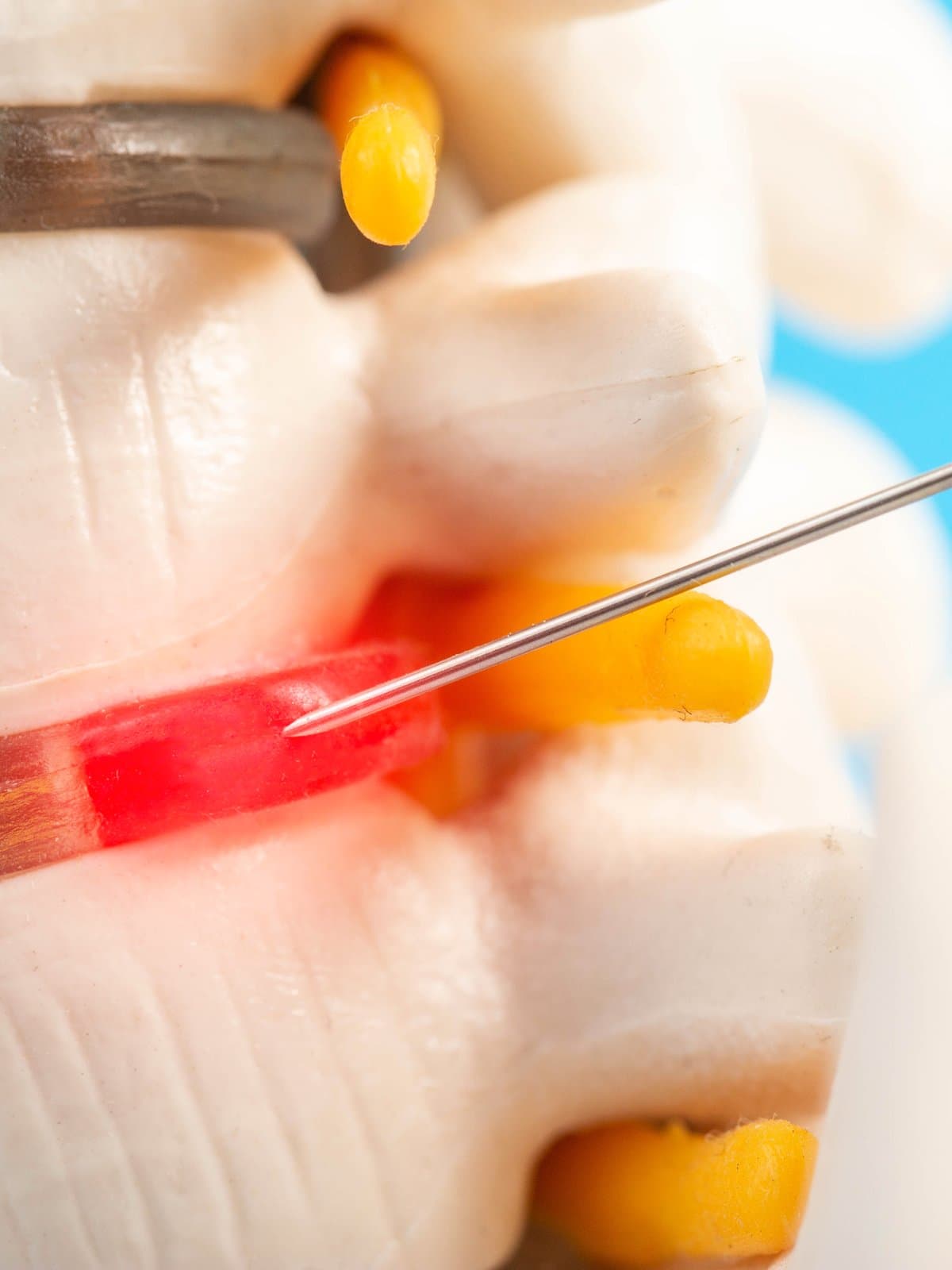 A needle inserted into the intervertebral disc space of a spine model, with the disc highlighted in red.