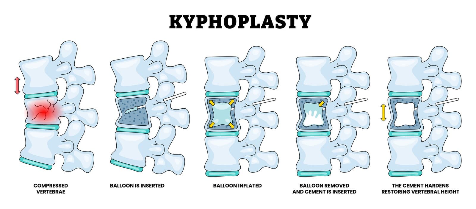 Five-panel diagram of the kyphoplasty procedure: compressed vertebrae, balloon inserted, balloon inflated, balloon removed and cement inserted, and the cement hardens to restore vertebral height.