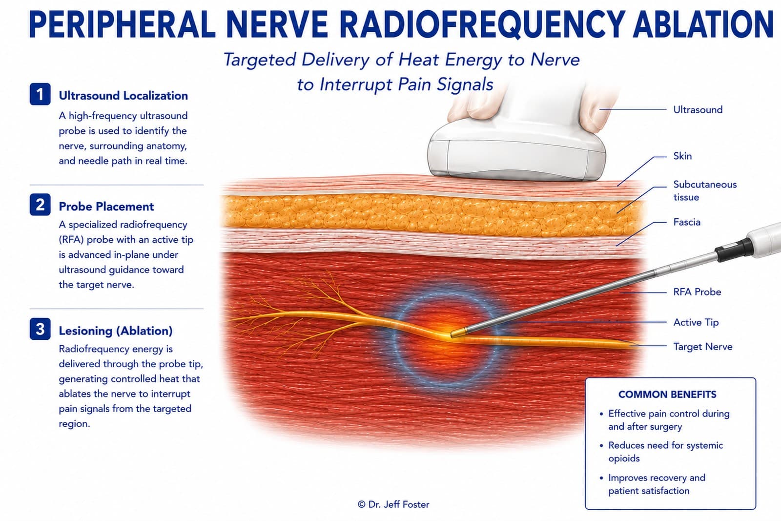 Diagram of peripheral nerve radiofrequency ablation: ultrasound localization, RFA probe placement, and lesioning, showing the active tip delivering heat energy to the target nerve.