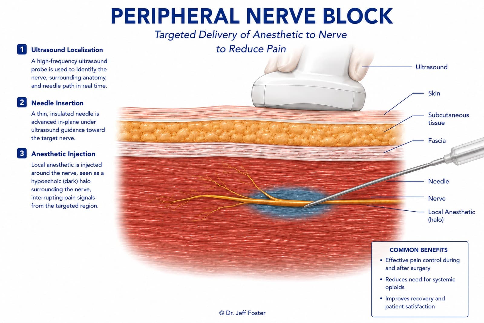 Diagram of an ultrasound-guided peripheral nerve block: ultrasound localization, needle insertion, and anesthetic injection, with anatomical labels for skin, subcutaneous tissue, fascia, needle, nerve, and local anesthetic.