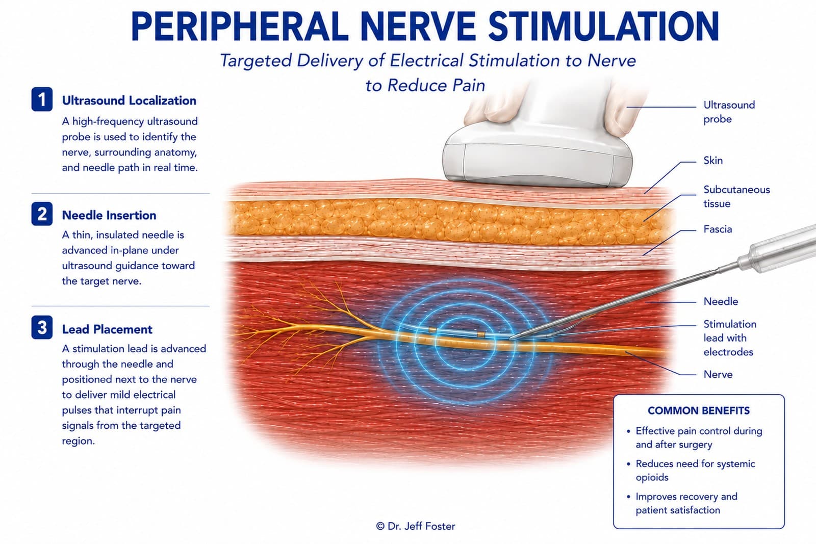 Diagram of peripheral nerve stimulation: ultrasound localization, needle insertion, and stimulation lead placement along the nerve to deliver electrical pulses that interrupt pain signals.