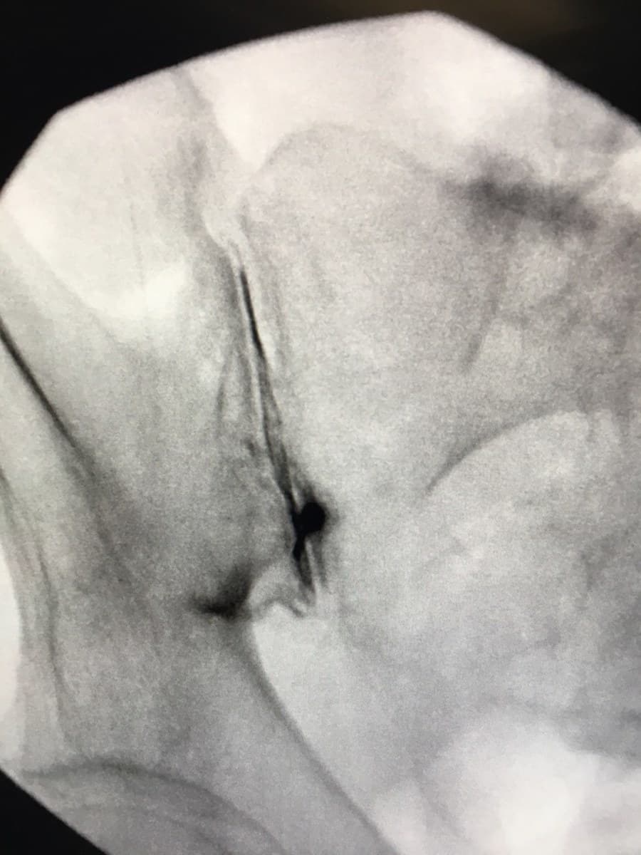 A fluoroscopic X-ray image showing contrast dye outlining the sacroiliac joint during an injection procedure.