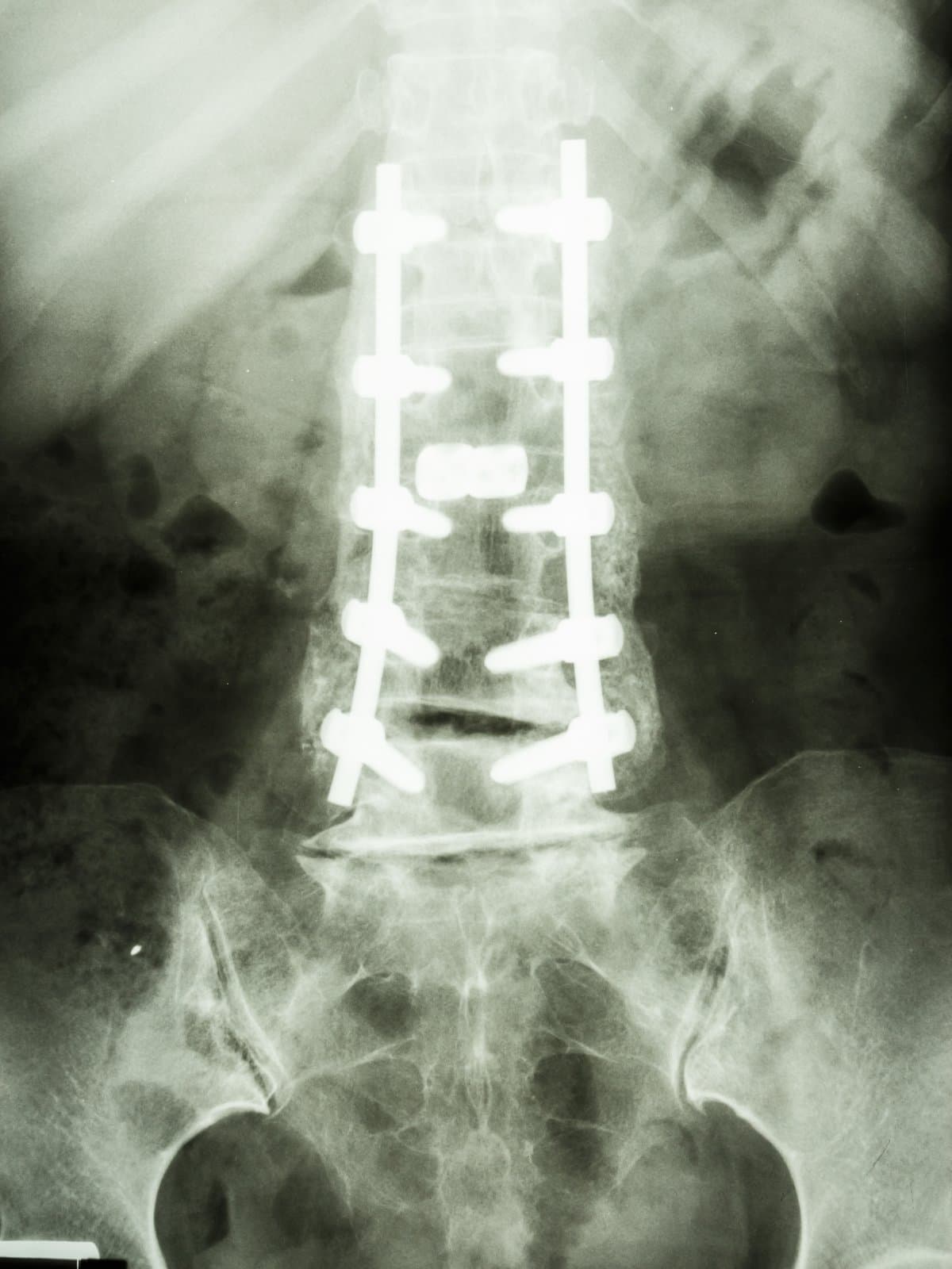 An X-ray of the lumbar spine showing pedicle screw fixation hardware.