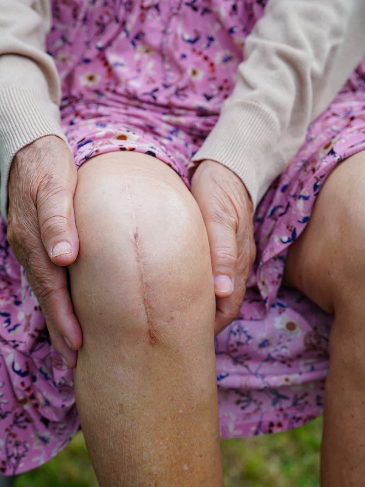 An elderly woman seated outdoors with visible surgical scars on both knees, hands resting gently on her knees.