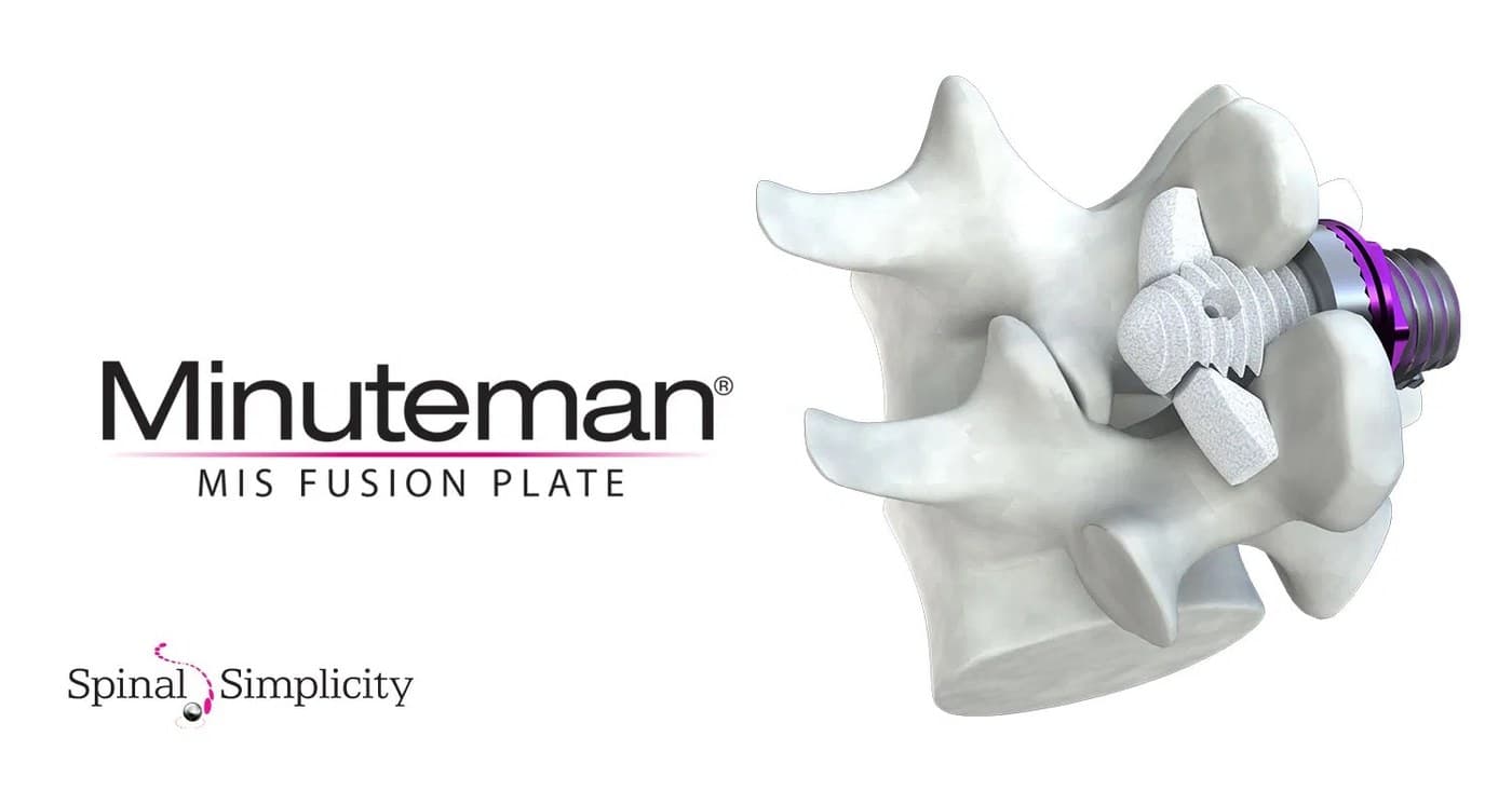 Minuteman MIS Fusion Plate diagram by Spinal Simplicity, showing the device implanted at the spinous process.