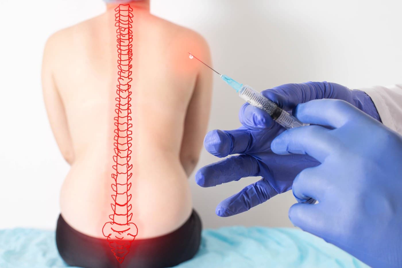 A physician in blue gloves holding a syringe, positioned near a patient's back with an illustrated overlay of the spine highlighting the sympathetic nerve chain.